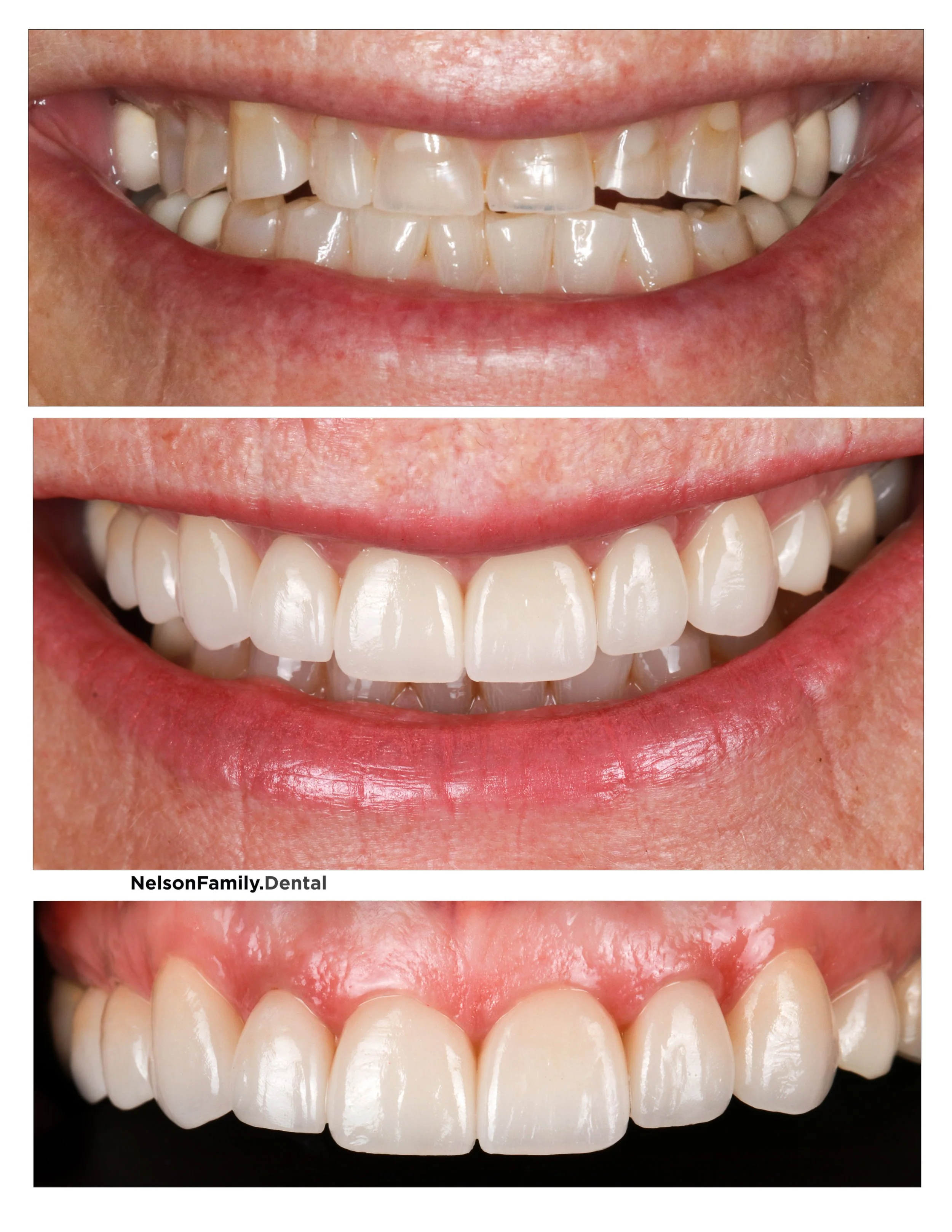 Crowns Before and After - day later post-op.jpg