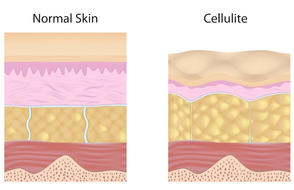 What is cellulite | Cellulite anatomy and physiology explained - in simple  terms - LipoTherapeia | London's cellulite experts