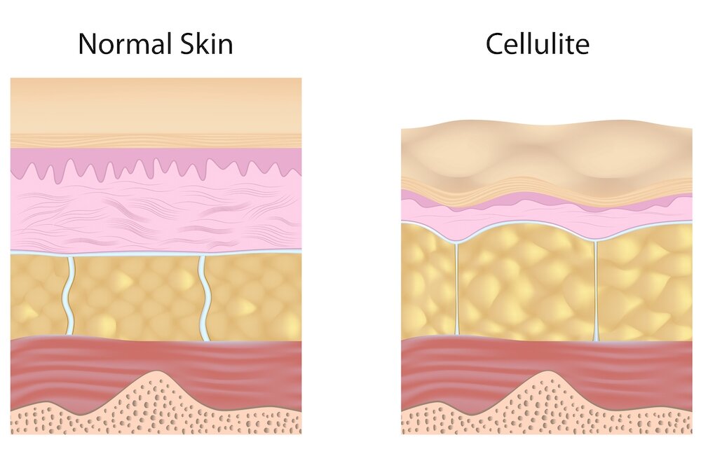 What is cellulite | Cellulite anatomy and physiology explained - in simple terms - LipoTherapeia | London's cellulite experts