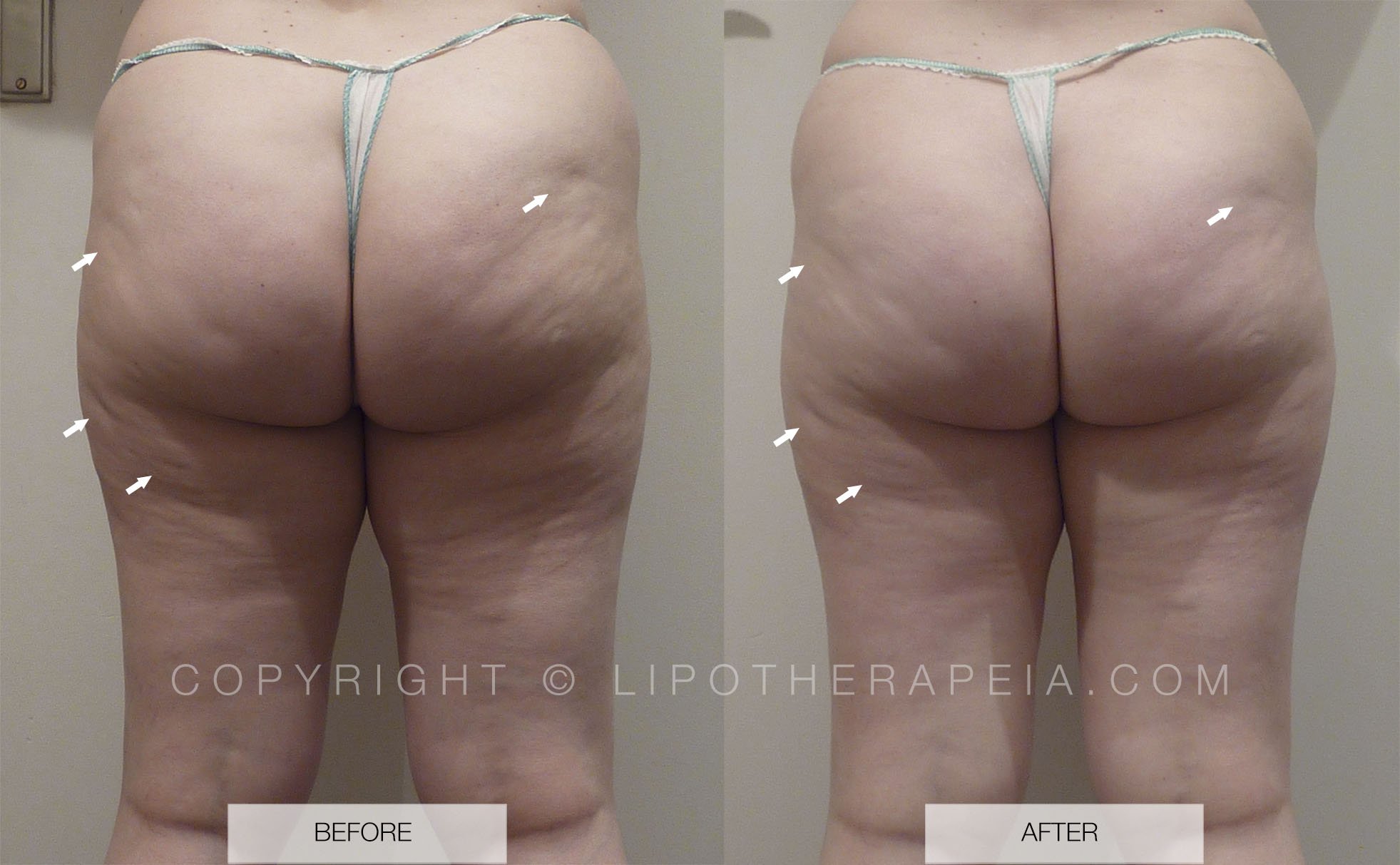 Cellulite before &amp; after pictures #4