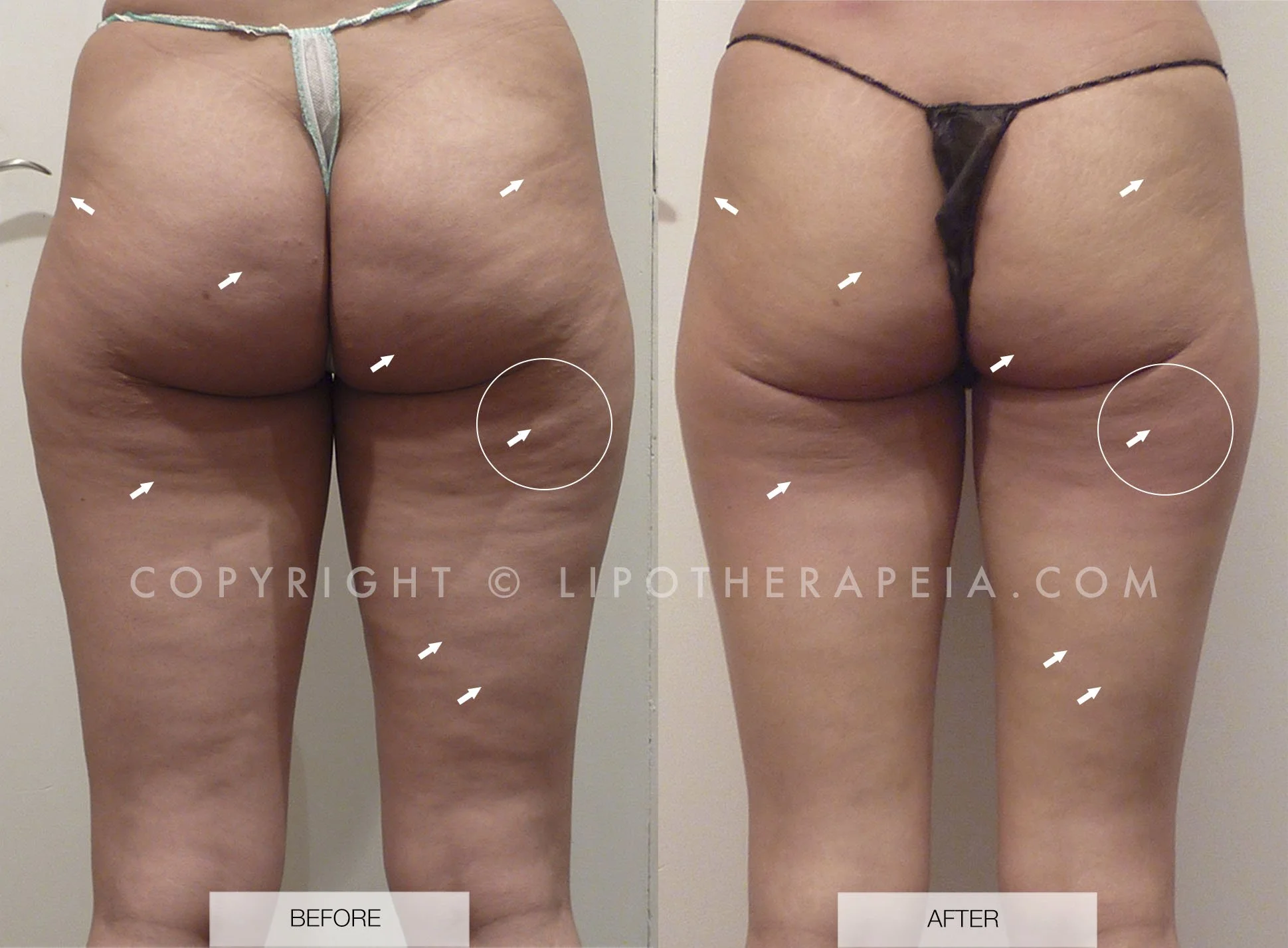 Cellulite legs before and after exercise hotsell
