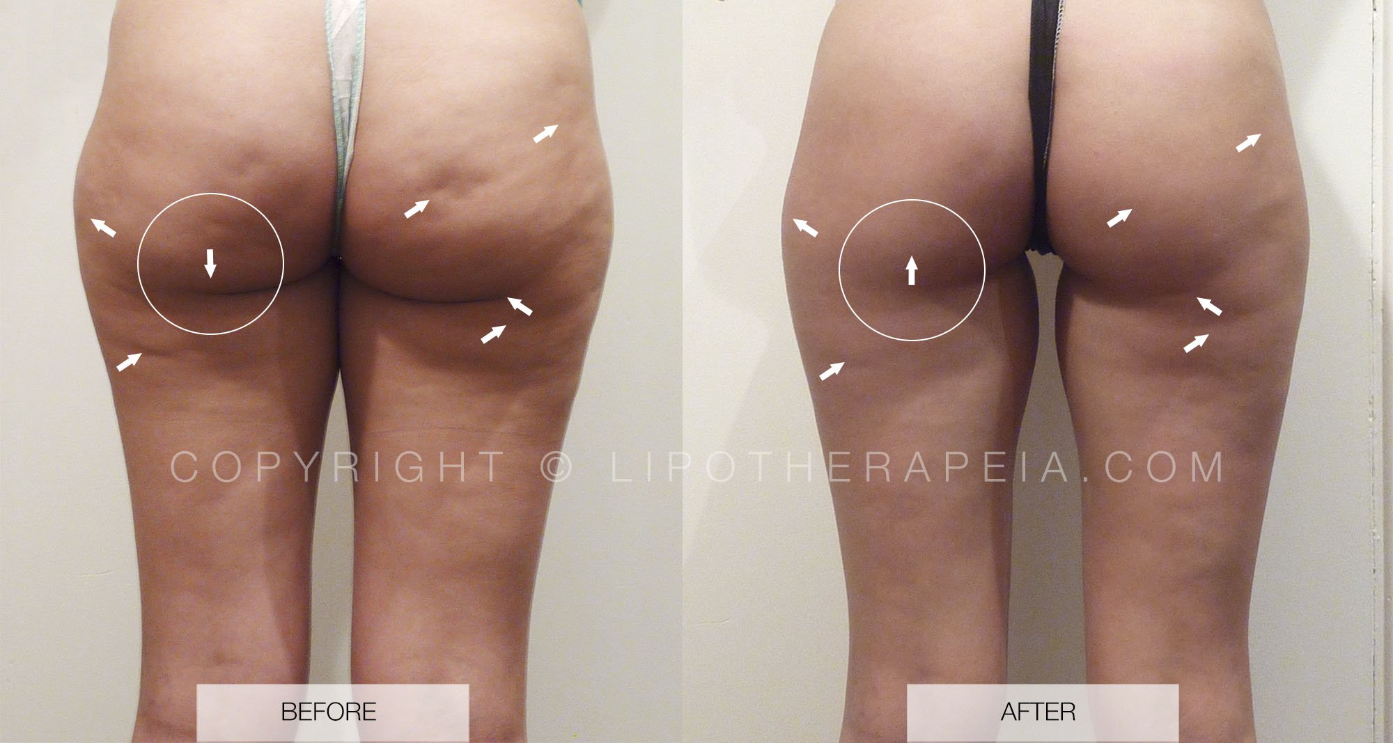 Cellulite before and after pictures #3