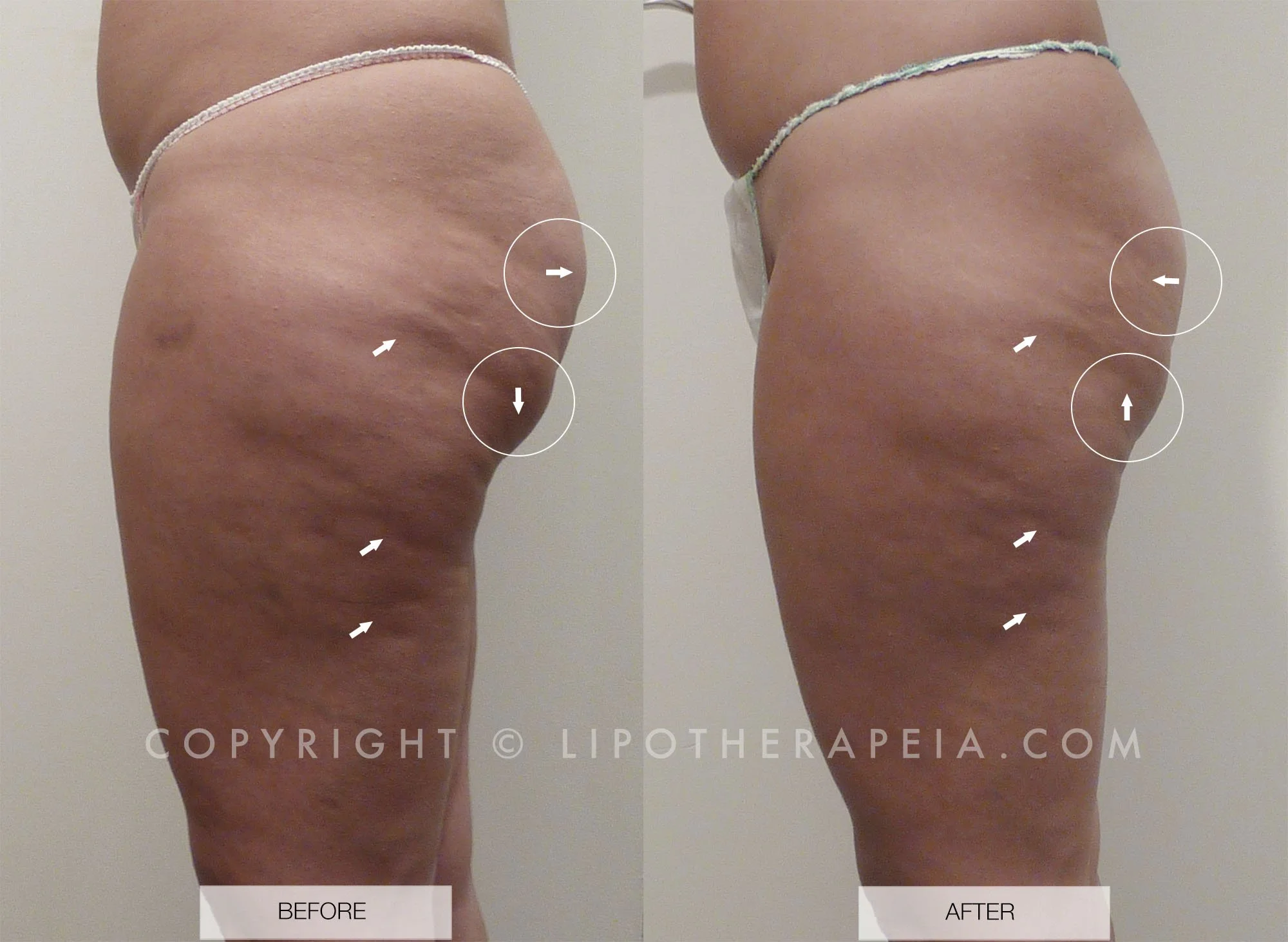 Cellulite Treatment before and after 4 weeks! Incredible Transformation is  waiting for you, the patient already tried 50 cellulite sessio