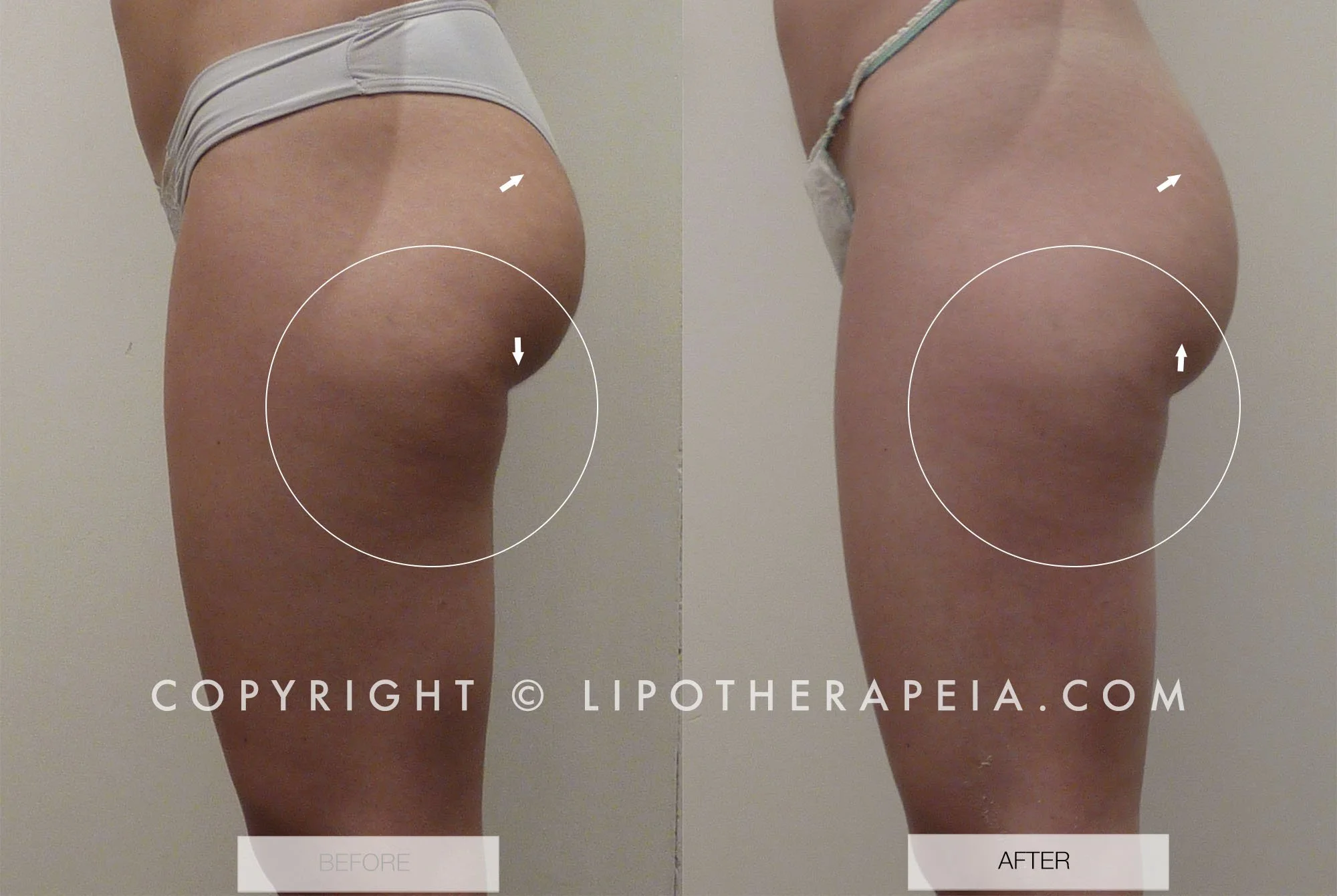 Cellulite before and after pictures #7