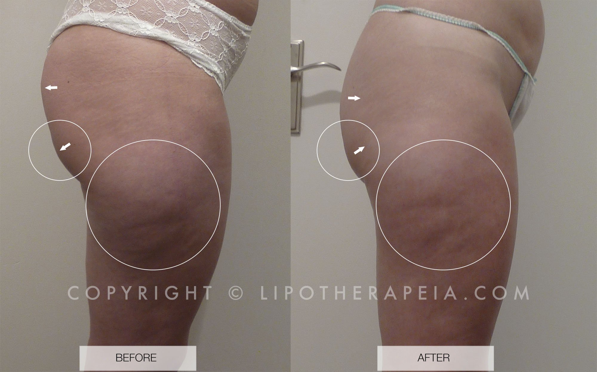 Cellulite before and after #6