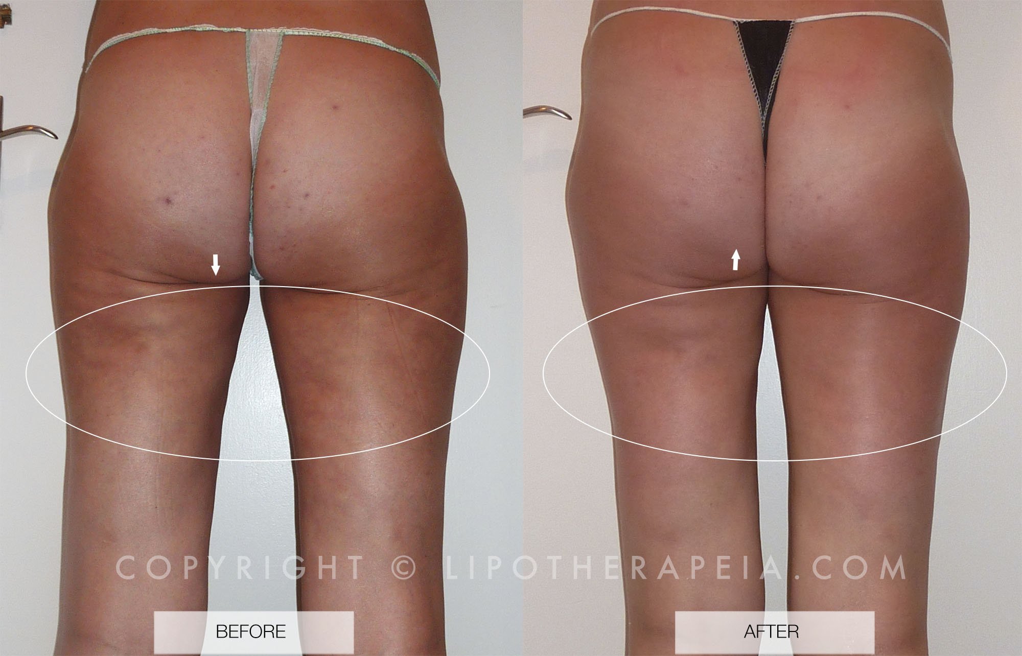 Cellulite before and after pictures #8