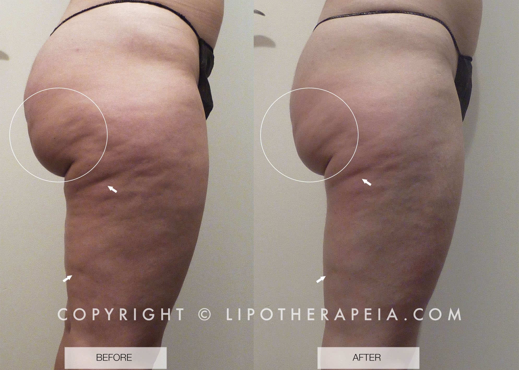 Cellulite / fat reduction before and after #9