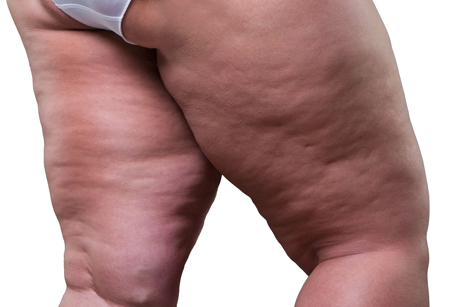 Can acoustic wave therapy (AWT) cure lipedema?