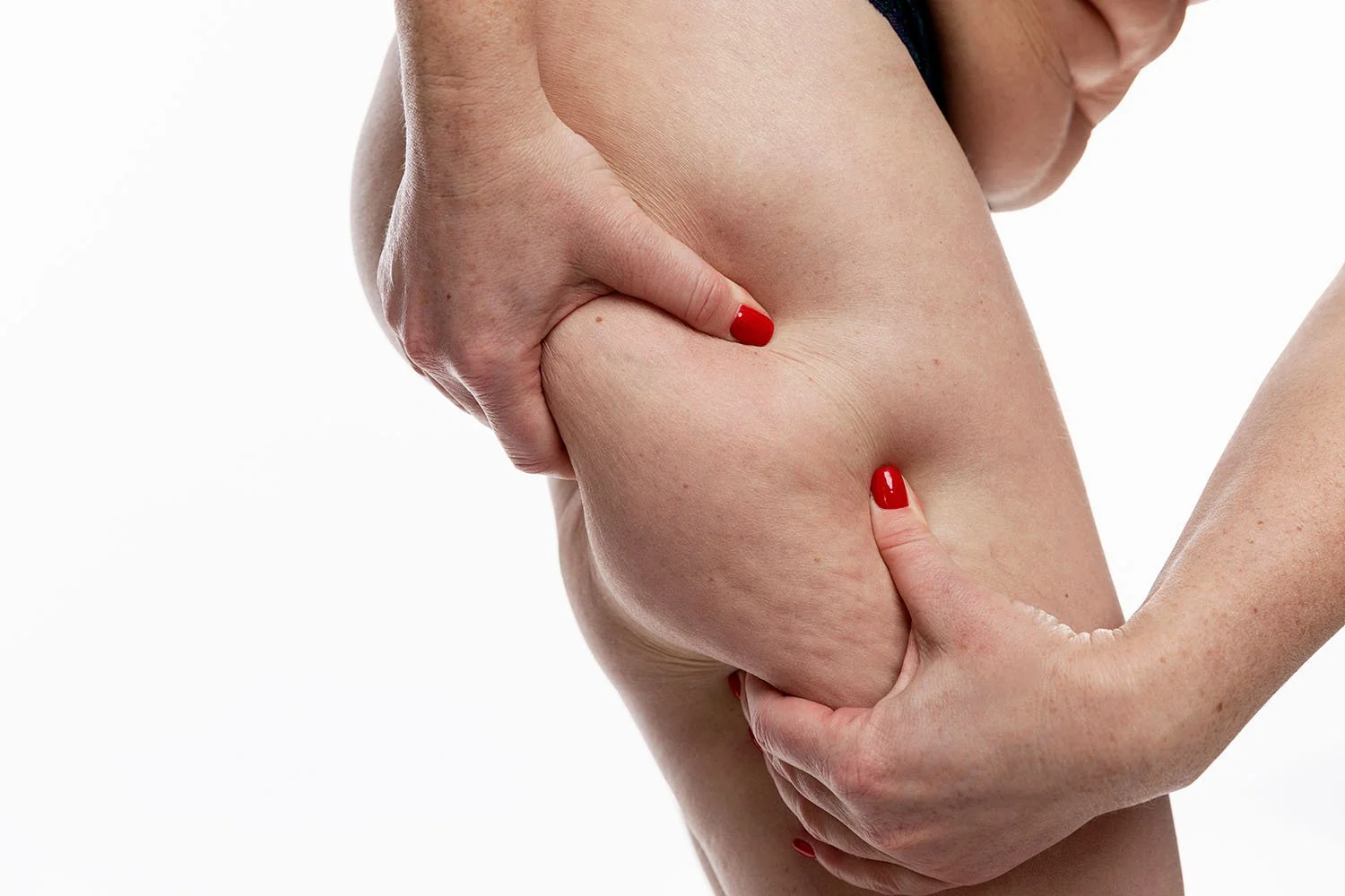 Advanced cellulite treatments after lipedema surgery