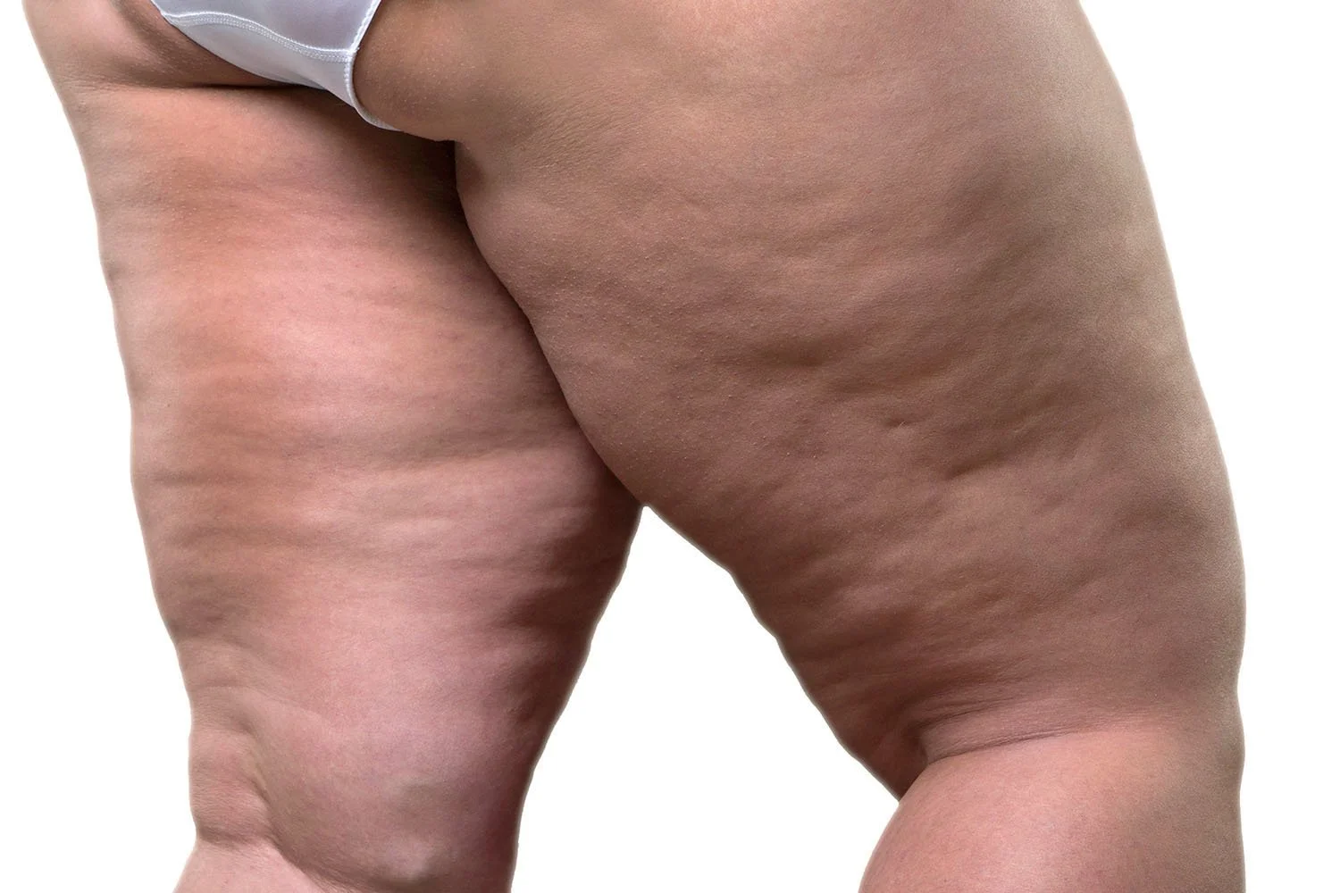 Advanced skin tightening treatments after lipedema surgery
