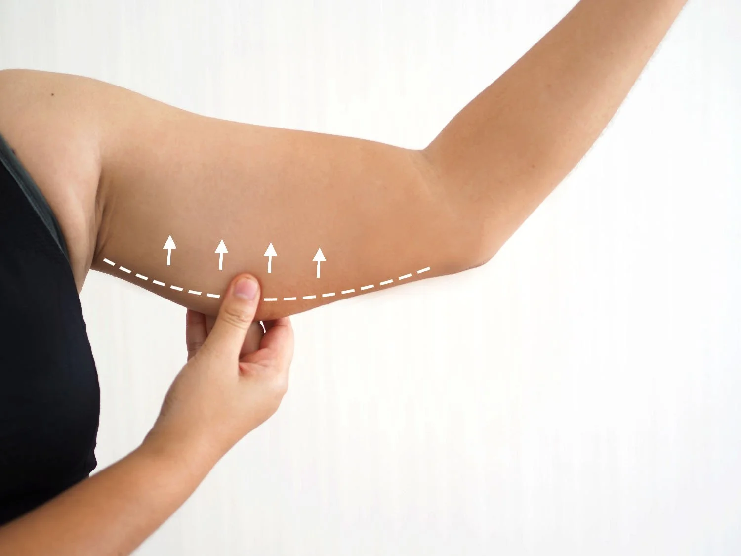 Advanced non-surgical arm lift treatments