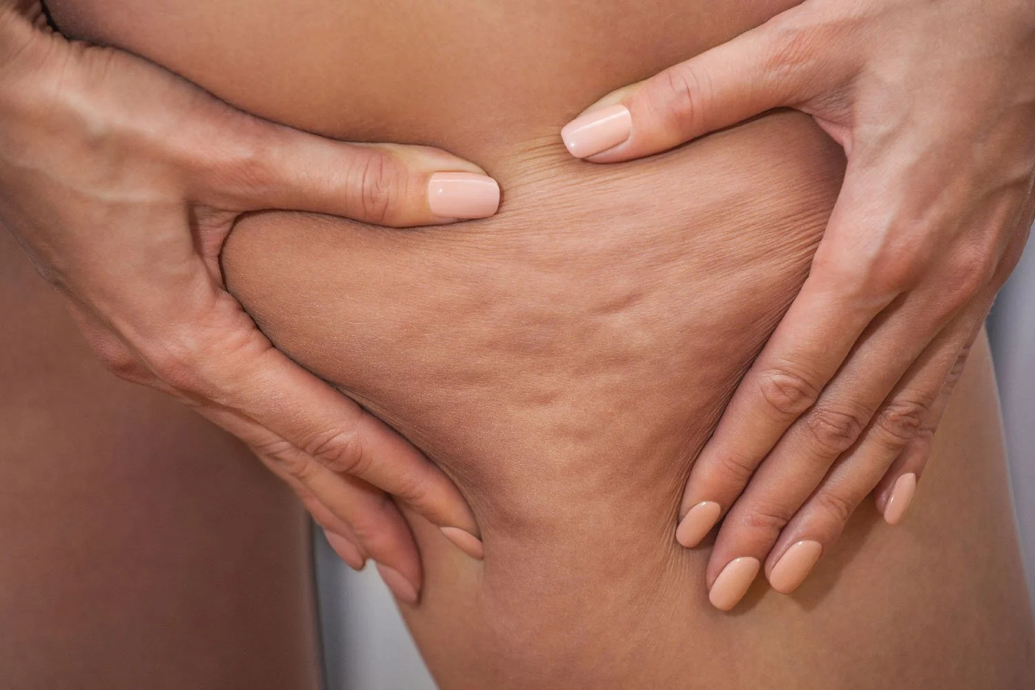 Ultrasound scan imaging of cellulite, fibrosis, lipedema &amp; skin laxity