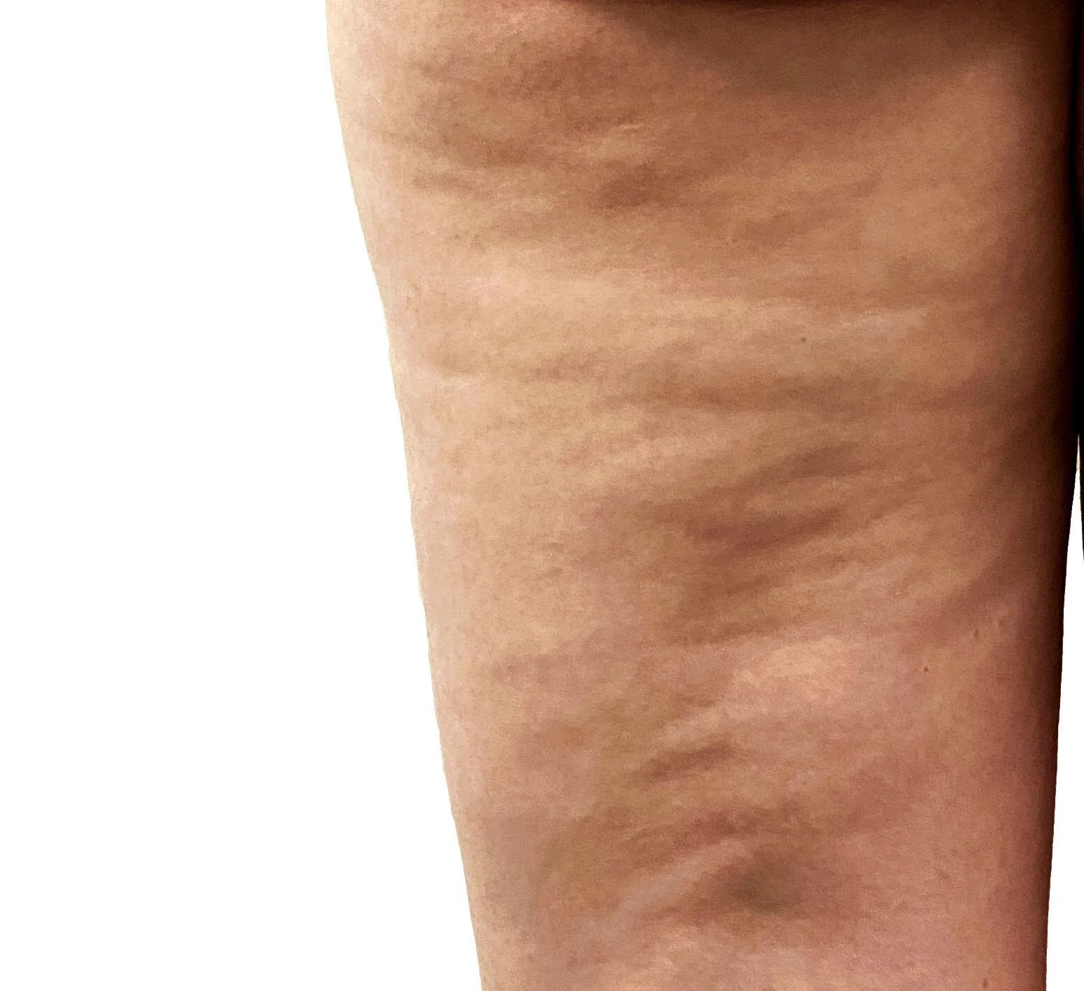 Ultrasound scan imaging of post-liposuction fibrosis