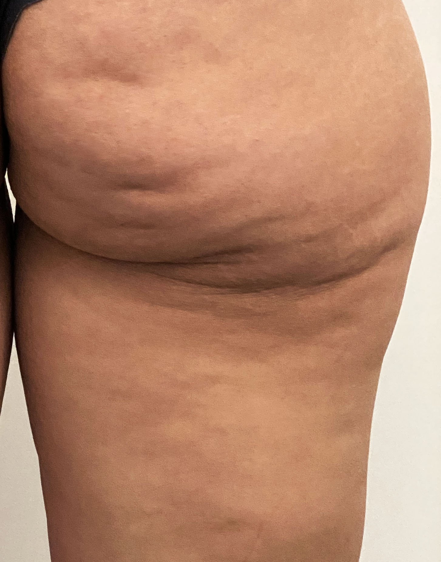 Assess your skin laxity with a specialised ultrasound skin scan