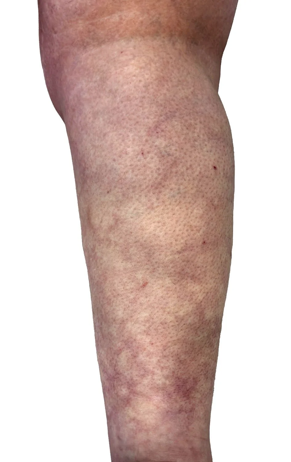 Assess your lipedema with a specialised ultrasound scan