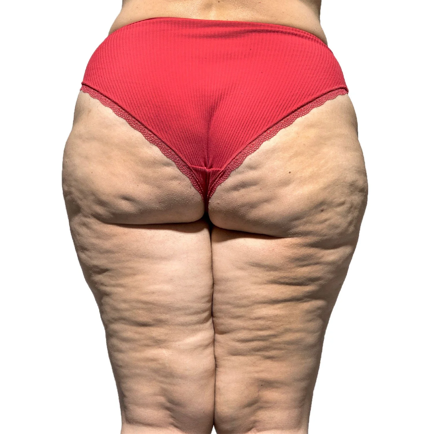 The Bespoke LipoTherapeia® Lipedema treatment