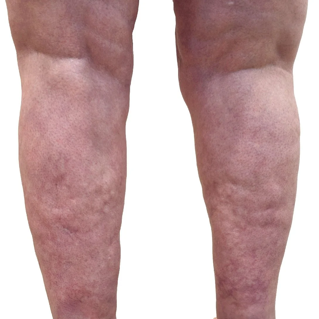 Assess your lipedema with a specialised ultrasound scan
