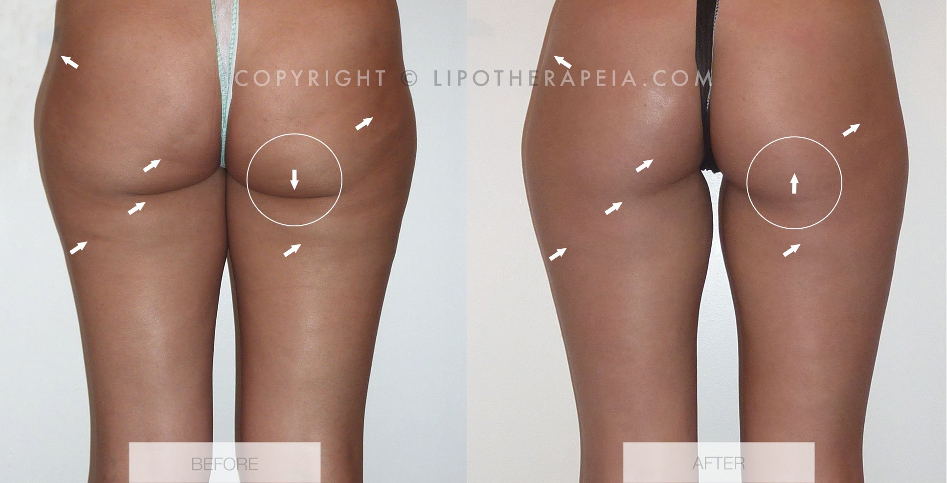 9x REAL cellulite treatment before and after pictures