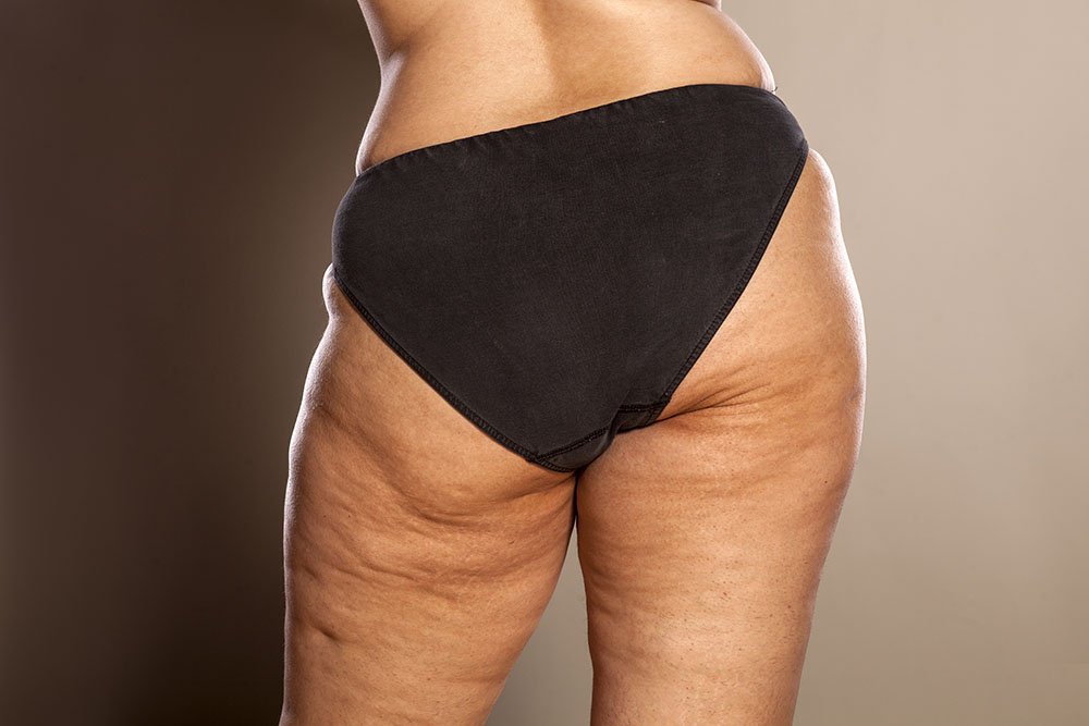 The 25-Second Trick For The Cellulite Myth - The Washington Post thumbnail