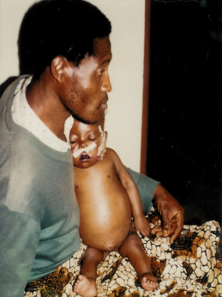 Mother has died, baby has developed severe malnutrition