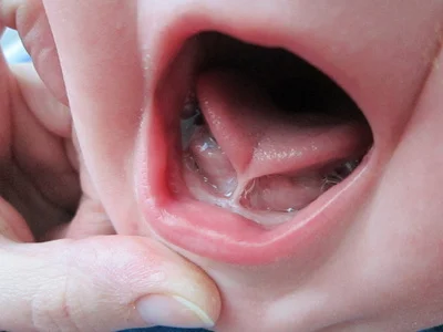 Tongue tie