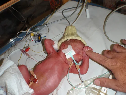 Blake's NICU Journey - Breathing and Living