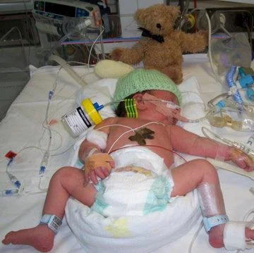 Charlie born full term with Tracheo Oesophageal Fistula (TOF)