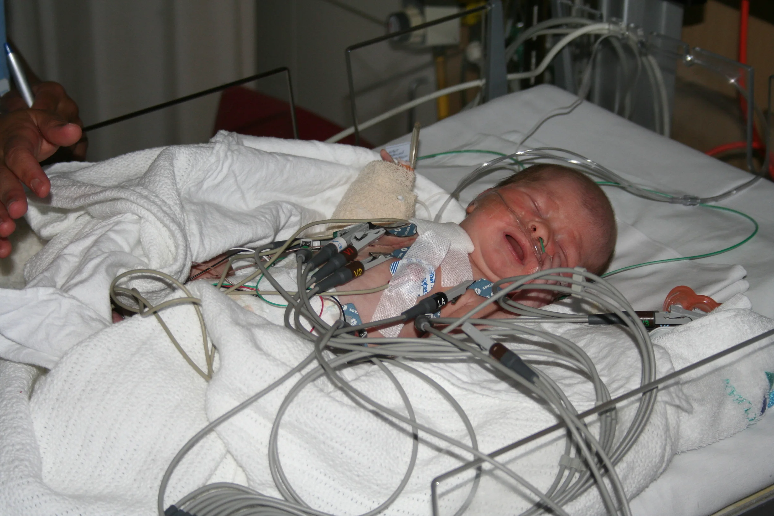 Second day in the Cardiac Ward and the Echo Machine diagnosed that Xavier had developed Super Ventricular Tachiachardia (SVT)