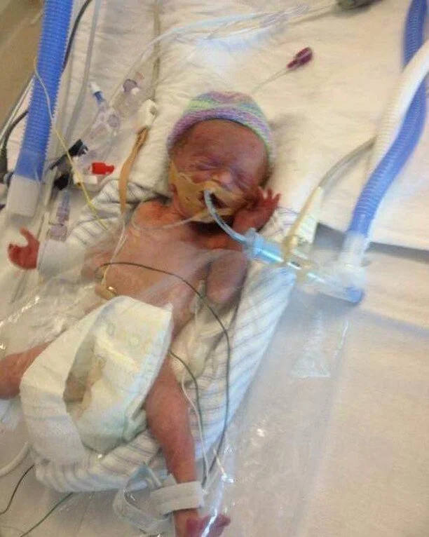 Shout out to little Lewi (ex 27 weeker, now in year 2) 

Lewi was told 7 month's ago that he was going blind in his left eye - which has been an ongoing issue from birth.  After 7 months of eye patching for 2 hours a day, his eye sight is now 'perfect'. So for the next 3 months at least, he is eye patch free.  They do not expect his sight to change again.
 
It&rsquo;s been a hard 7 month's, with lots of tears, arguments, questions but he has done the hard work and it has paid off. 

Lewi wanted to share his story so he can inspire any other Tiny Sparks that may be going through a similar journey. 
(And their mums and dads too)

Dont give up he says "it will be worth it in the end" 

Love Lewi x