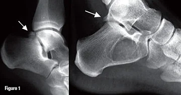 Os trigonum (left), Stieda process (right)
