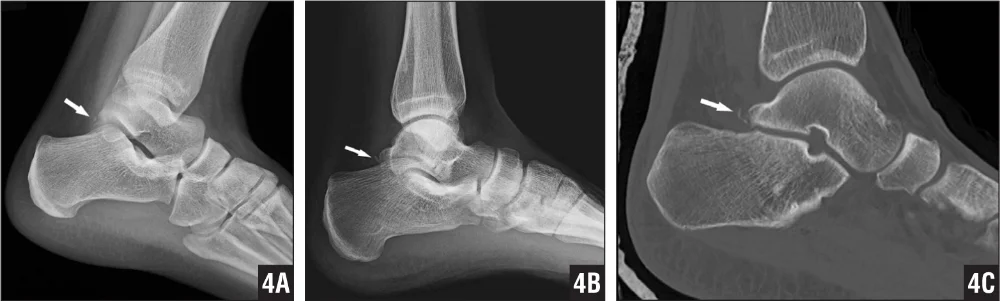 A patient with a fracture of the Stieda process