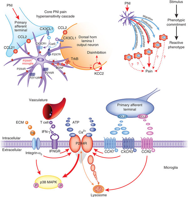 Neuropathic pain (image from google images). 