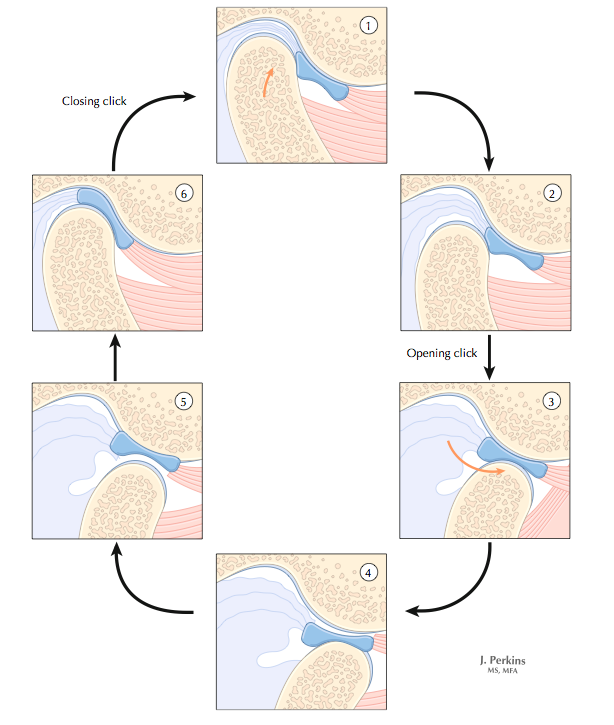 Disc displacement with reduction during opening (Cleland & Koppenhaver, 2007. p.54)