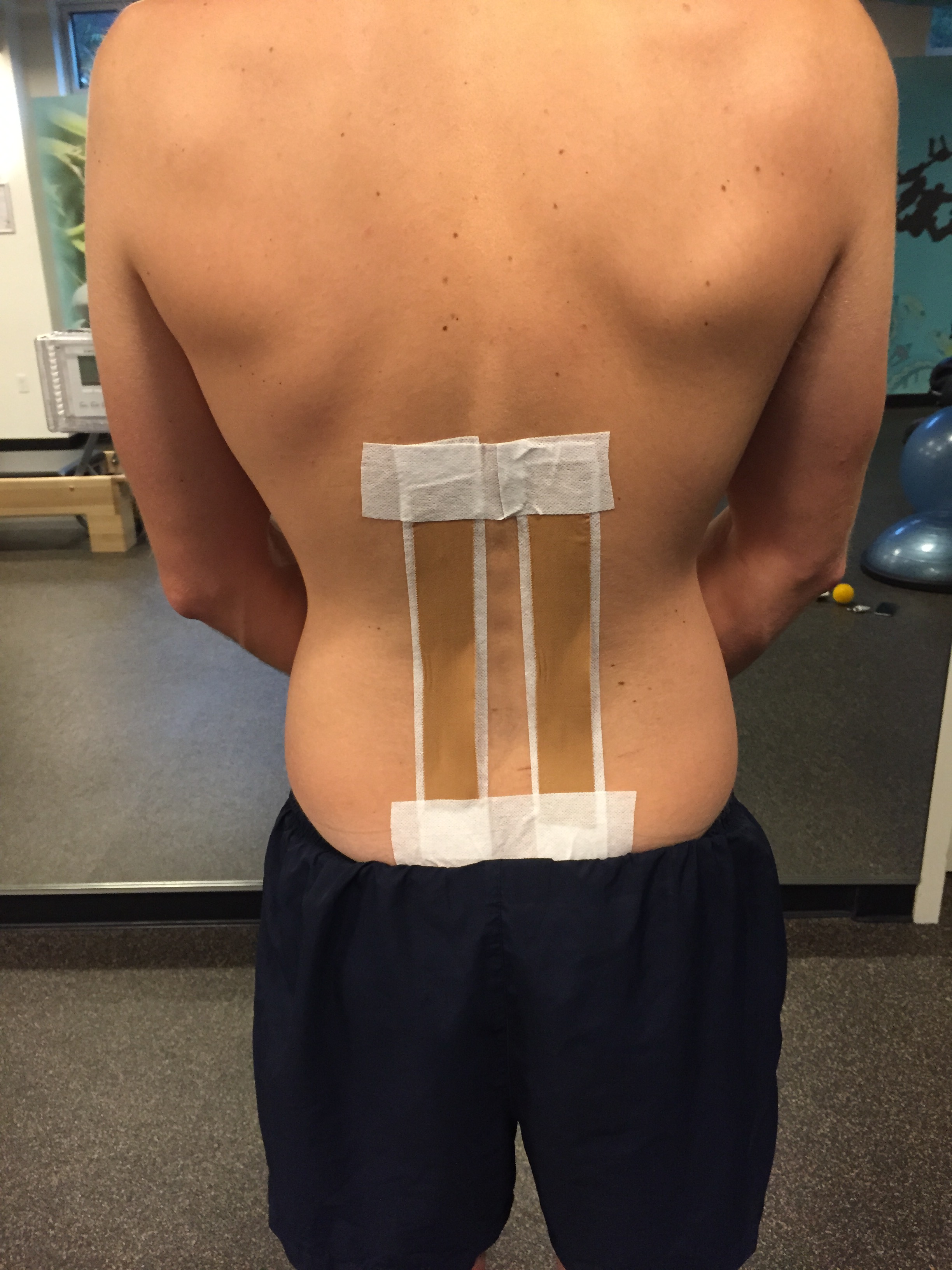 Taping with vertical strips will block lumbar flexion. I use this taping when I am trying to increase proprioception and patient awareness about their lumbar flexion during functional movements. 