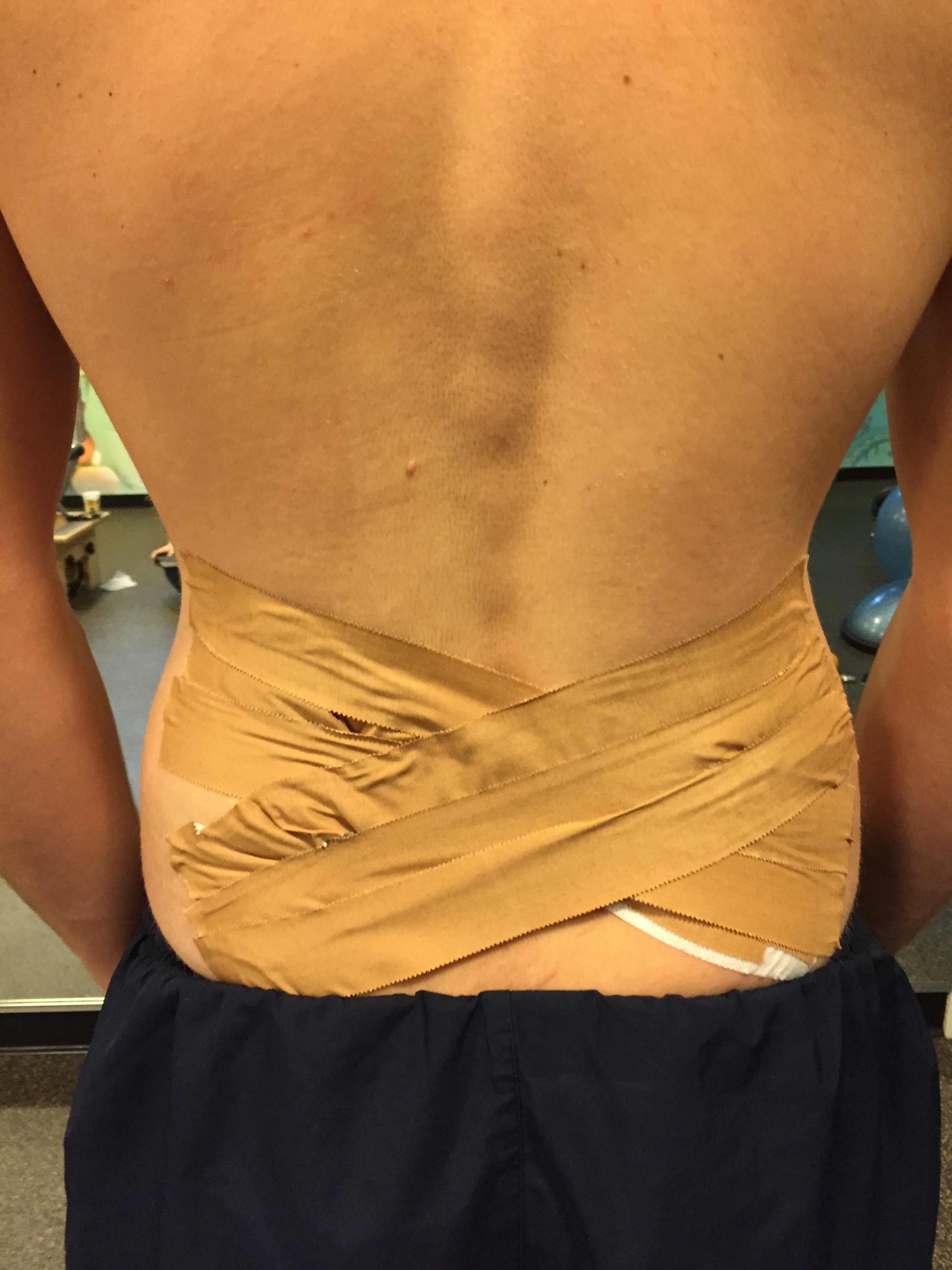 Taping in a criss-cross overlap with help reduce muscle activation across the lower back. I use this taping when I feel patients need to be supported and unloaded. (I always use fixomull first to reduce any skin irritation from the pull I place on the strapping tape to unload the spine - not shown well here). 