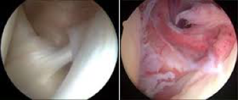 (Arthroscopic view of frozen shoulder on the right Pain> stiffness)