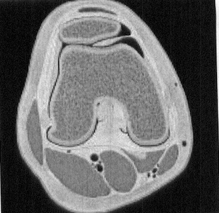 Axial graphic shows a thickened and elongated medial parapatellar plica &nbsp;interposed between the patella and trochlea. The plica undergoes repetitive trauma in this location. (Andrew Sonin, StatDx, retrieved August 24th, 2015)
