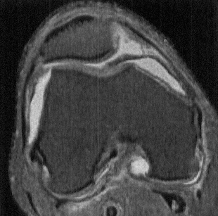 Axial PDWI FS MR shows a thick, irregular, and undulating medial parapatellar plica extending deep into the trochlear notch, and interposed between the medial trochlea and patella. Such plicae can become inflamed and thickened due to repetitive trauma during knee motion, setting up a vicious cycle of trauma and inflammation. (Andrew Sonin, StatDx, retrieved August 24th, 2015)