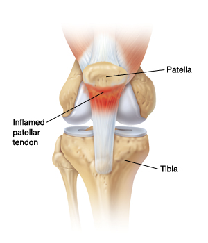 Patella Tendinopathy & the 4-stage management program for 'Jumper's knee' —  Rayner & Smale