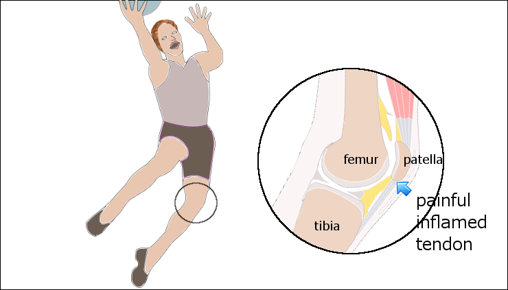 Patella Tendinopathy & the 4-stage management program for 'Jumper's knee' — Rayner & Smale