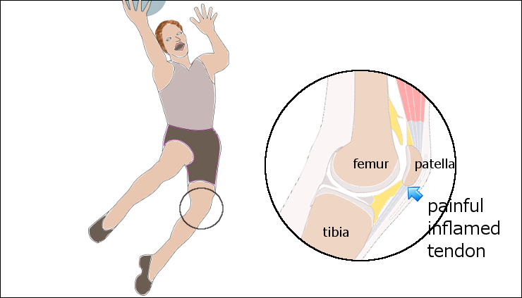 Patella Tendinopathy & the 4-stage management program for 'Jumper's knee' —  Rayner & Smale