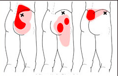 Image courtesy of Google Images of MTP of gluteus medius