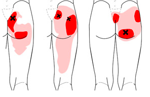 Image courtesy of Google Images of MTP of gluteus maximus