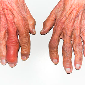 http://www.healthline.com/hlcmsresource/images/slideshow/rheumatoid-arthritis-symptoms-women/285x285_Rheumatoid_Arthritis_Symptoms_In_Women_Deformity_7a.jpg