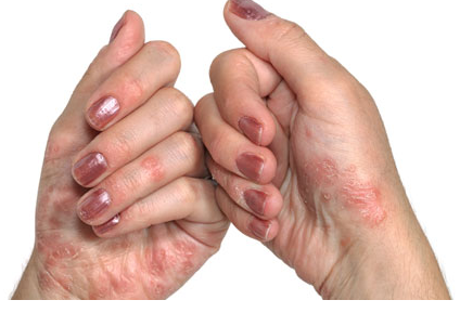 http://images.medicinenet.com/images/psoriasis-hand.jpg
