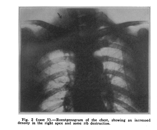 (Pancoast, 1932, p. 1393)