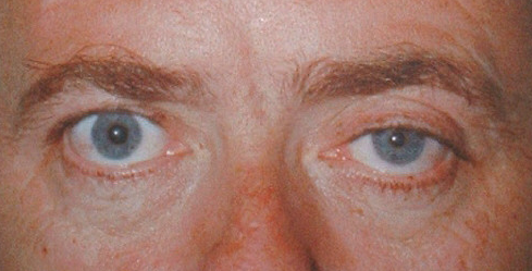 Horner's Syndrome. Image courtesy of Google Images
