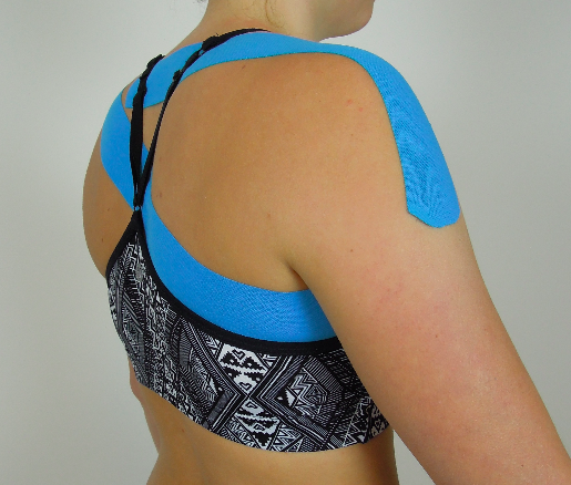 Taping scapula upward rotation & posterior tilt