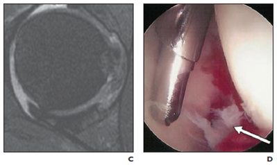 MRI Arthrogram (fraying at 3 o'clock)&nbsp; &nbsp; &nbsp; &nbsp; &nbsp; Arthroscope