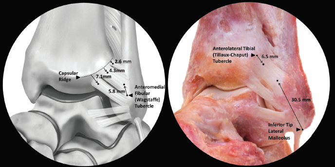 Picture 2. Anterolateral view of AITFL. (Williams 2015, pg 93).